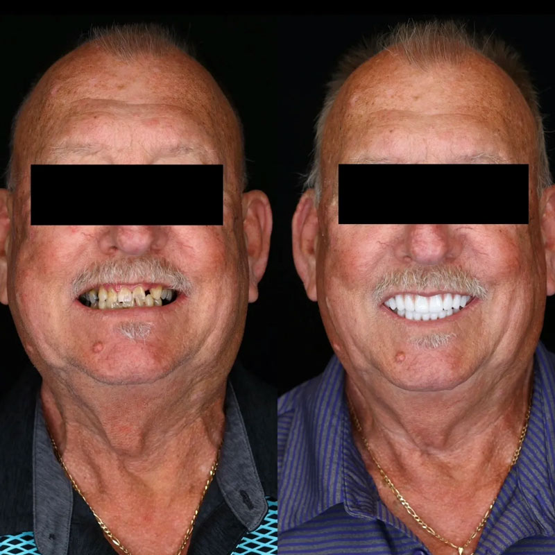 Dental Implant Before Afters in West Chester