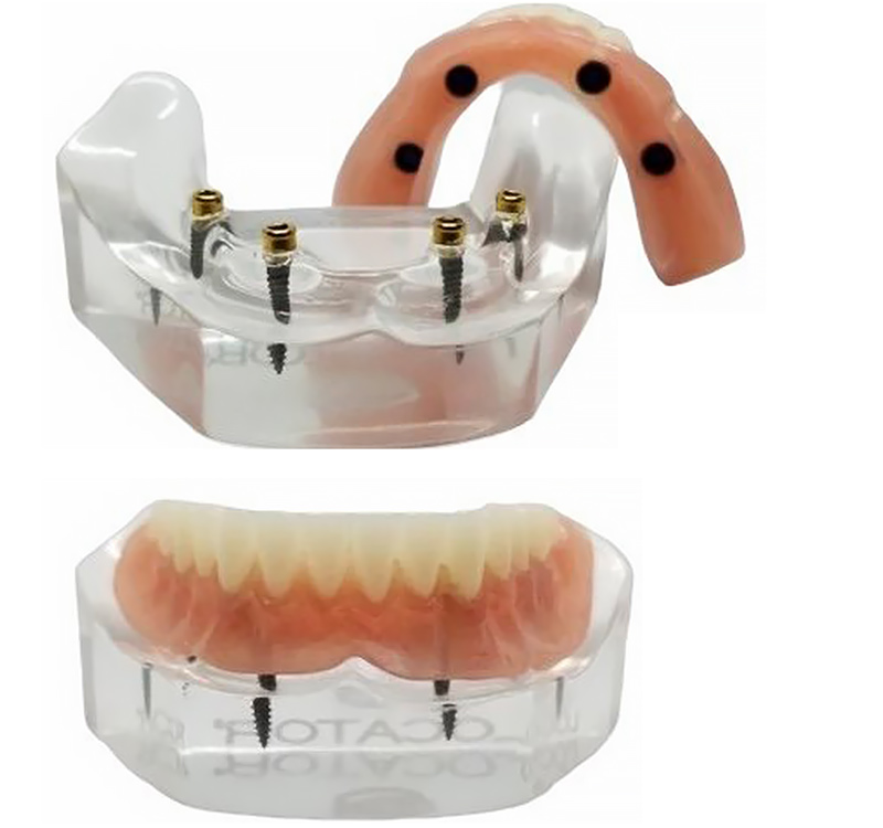 Snap-In Implant Dentures (Removable) in West Chester