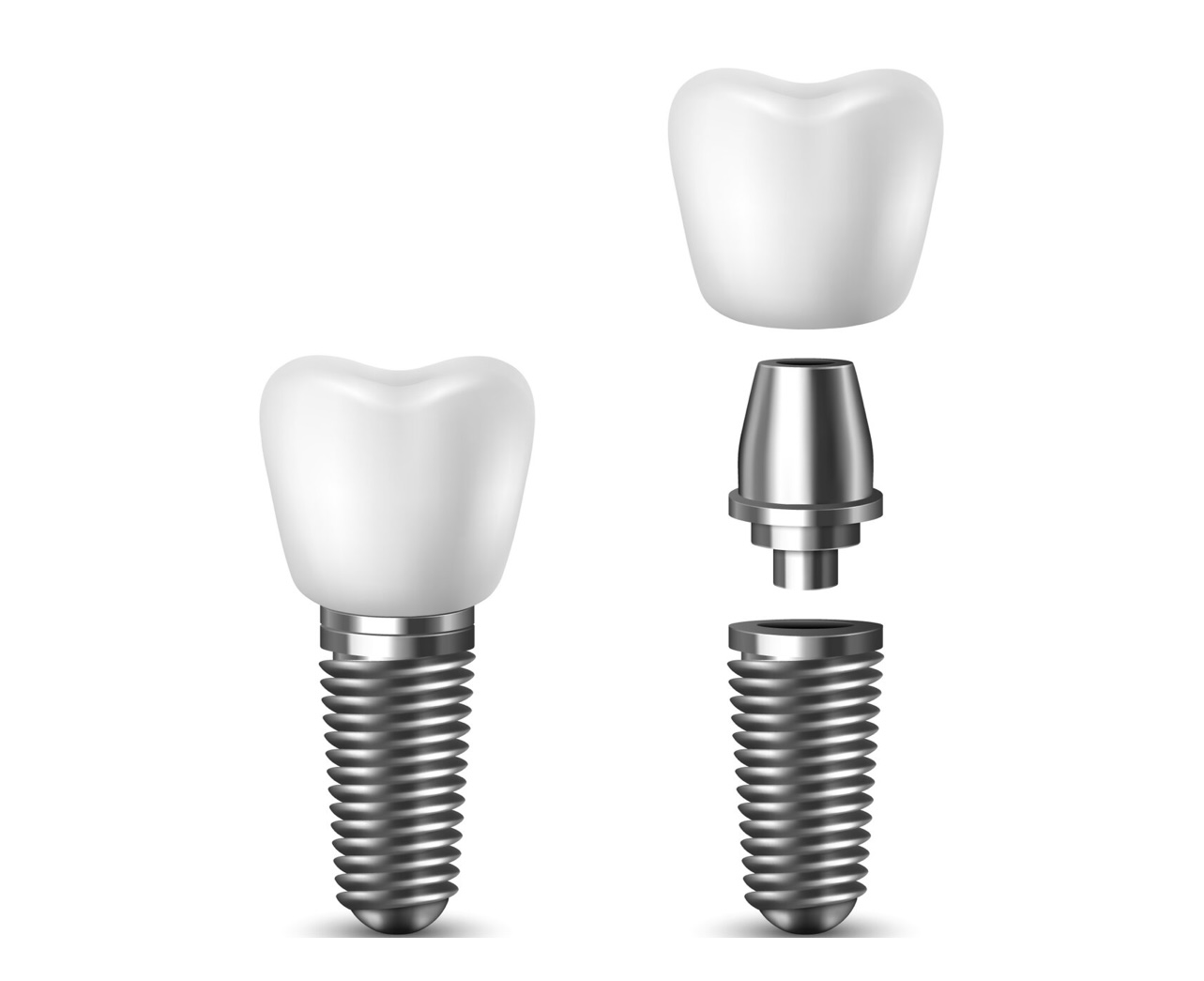 Dental Implants- Welcome To Ohio Implants And Dentures